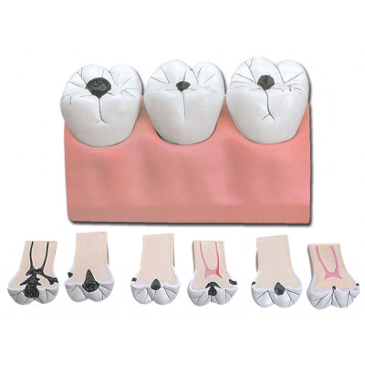 DENTAL CARIES