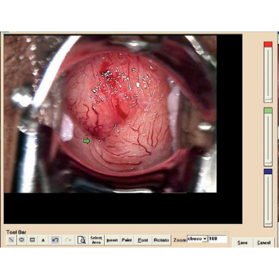 SOFTWARE VIDEO COLPOSCOPE MULTILANGUAGES